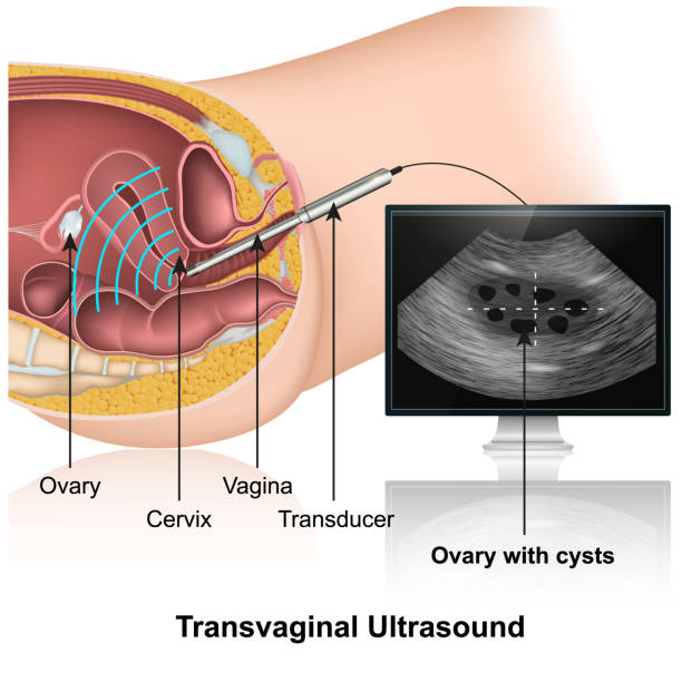 Ultrassom transvaginal particular